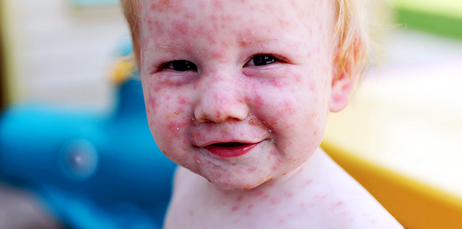 Approach to Child with Rash I